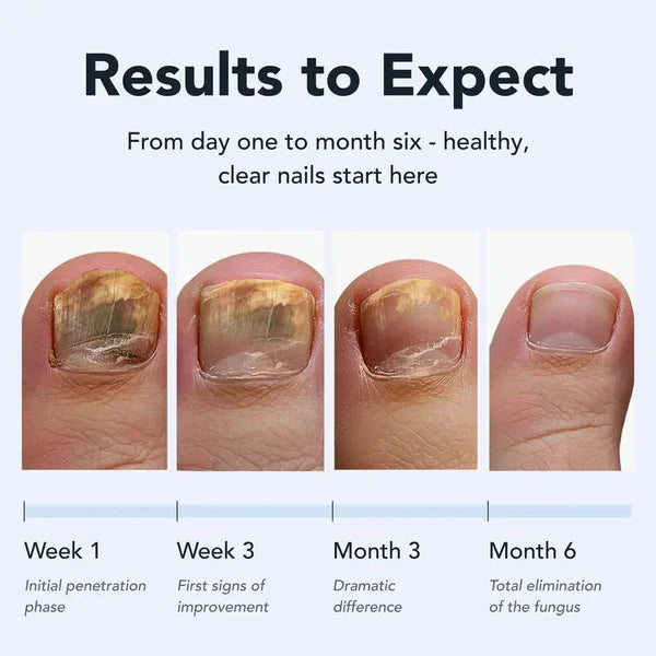 Toenail Fungus Pen - UNDECYLENIC ACID 25% - Daily Solution for Brittle & Thickened Nails