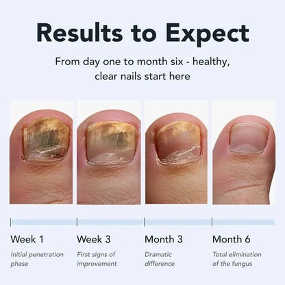 Toenail Fungus Pen - UNDECYLENIC ACID 25% - Daily Solution for Brittle & Thickened Nails